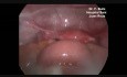 Laparoscopic Treatment of Jejunal Perforation in Blunt Abdominal Trauma