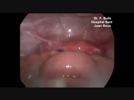 Laparoscopic Treatment of Jejunal Perforation in Blunt Abdominal Trauma