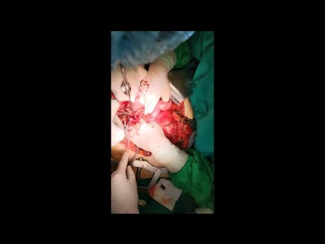 Surgical Graft Thrombectomy After Pancreatoduodenectomy