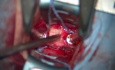 Anterior Cervical Discectomy and Fusion at C3–C4 (ACDF)