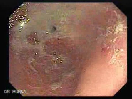 Adenocarcinoma of the cardias (1 of 14)
