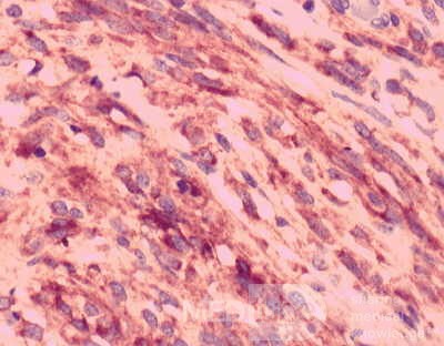 Gastrointestinal Stromal tumor (GIST) (62 of 65)