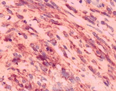 Gastrointestinal Stromal tumor (GIST) (62 of 65)