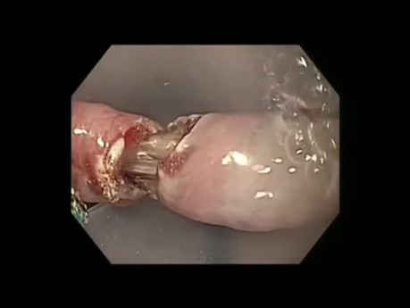 Zenker Diverticulum. Endoscopic Treatment.