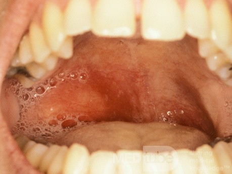 Peritonsillar Abscess
