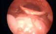 Epiglottis Swiss