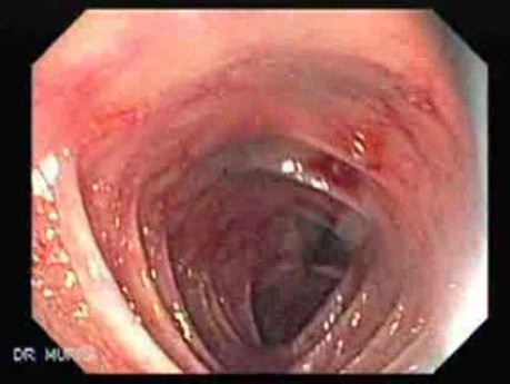 Colon Angiodysplasia (9 of 24)