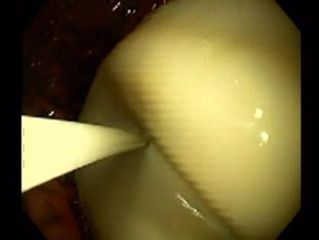 Endoscopic Balloon Removal (2 of 9)