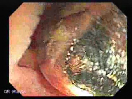 Dental Prothesis Found in the Jejuno (1 of 9)