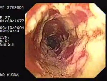 Oropharynge-Esophagic Candidiasis (1 of 5)