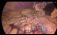 Laparoscopic Wedge Resection - Grater Gastric Curve GIST