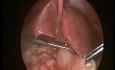 Hypertrophic Pyloric Sterosis in Infant