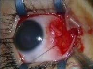 BMR For Infantile Esotropia - Hang-Back Technique