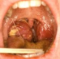 Mono Tonsillitis with Airway Compromise