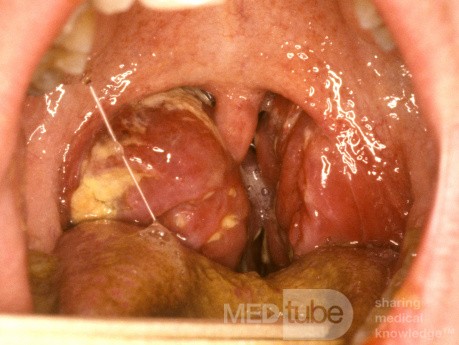 Mono Tonsillitis with Airway Compromise