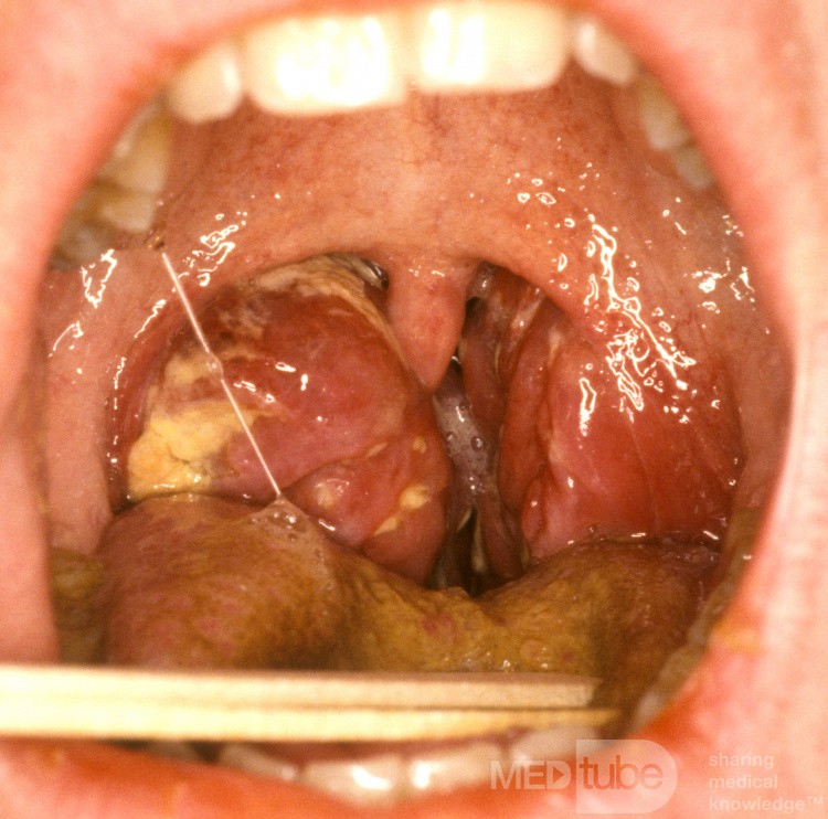 Mono Tonsillitis with Airway Compromise