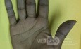 Raynaud's Phenomenon