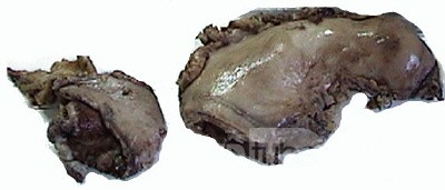 Plastic Linitis with bilateral Krukenberg´s tumor (11 of 13)