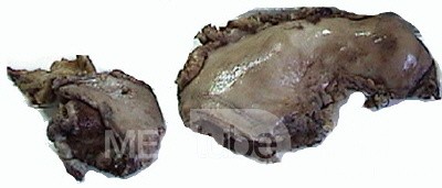 Plastic Linitis with bilateral Krukenberg´s tumor (11 of 13)