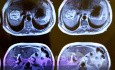 Liver Hydatid Cyst Profection to CBD and Cholangitis and Extraction of Doughter Cyst with ERCP