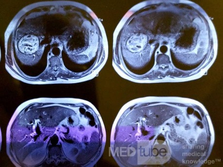 Liver Hydatid Cyst Profection to CBD and Cholangitis and Extraction of Doughter Cyst with ERCP