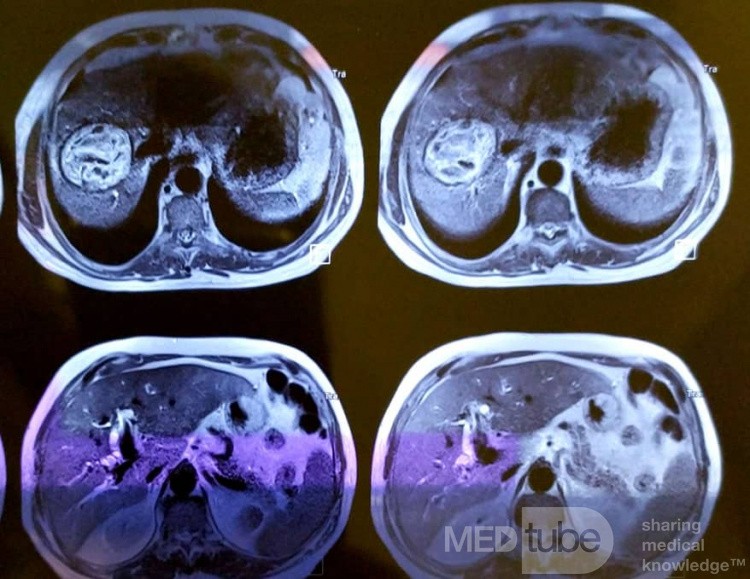 Liver Hydatid Cyst Profection to CBD and Cholangitis and Extraction of Doughter Cyst with ERCP