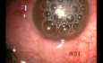 Traumatic Glaucoma & Uveitis - Microtrack Filtration