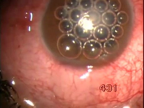 Traumatic Glaucoma & Uveitis - Microtrack Filtration