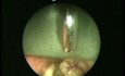 Biopsy of Ventricular Polyp