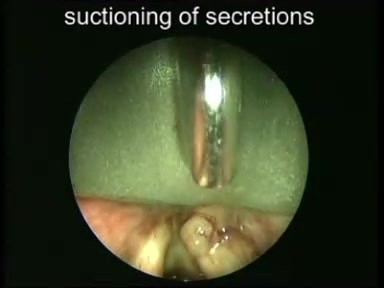 Biopsy of Ventricular Polyp