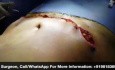 Lipo-Abdominoplasty Surgery