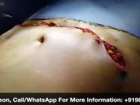 Lipo-Abdominoplasty Surgery