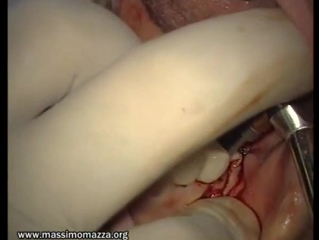 Intra-Grafting Procedures (2/2)