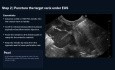EUS Guided Coil & Glue Embolization of Duodenal Varices