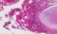 Squamous cell carcinoma - Histopathology - Lung