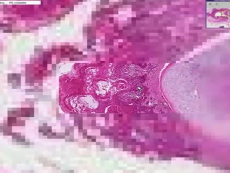 Squamous cell carcinoma - Histopathology - Lung