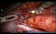 Sixth Segmentectomy - Left Lung