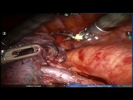 Sixth Segmentectomy - Left Lung