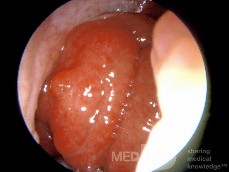 Enlarged Adenoids in an Adult