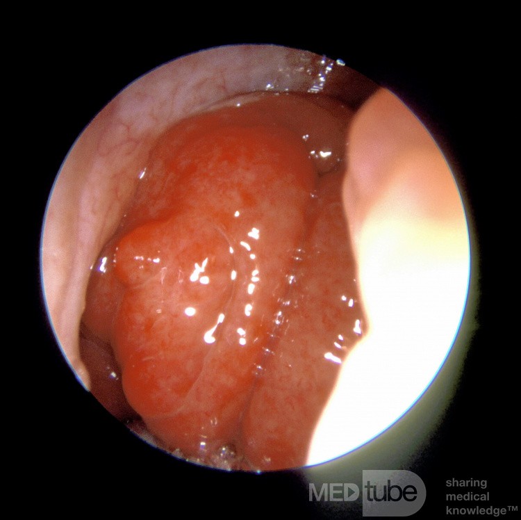 Enlarged Adenoids in an Adult