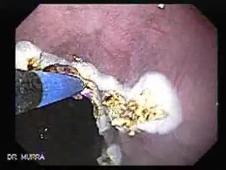 Barrett's Esophagus of long segment (8 of 11)