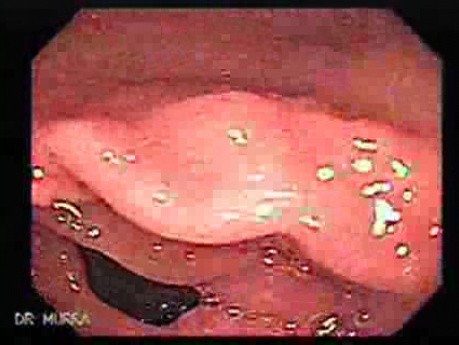 Follicular Lymphoid Hyperplasia (2 of 4)