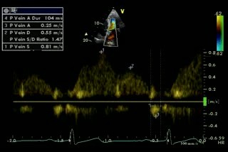 Pulmonary Vein Flow Normal