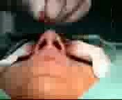 Nose tip refinement 
