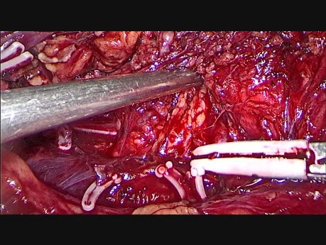 Laparoscopic Retroperitoneal Lymphadenectomy