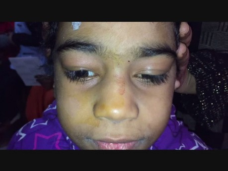Severe Marcus Gunn Ptosis, Result of Singh Orbital Approach Technique of LPS Advancement