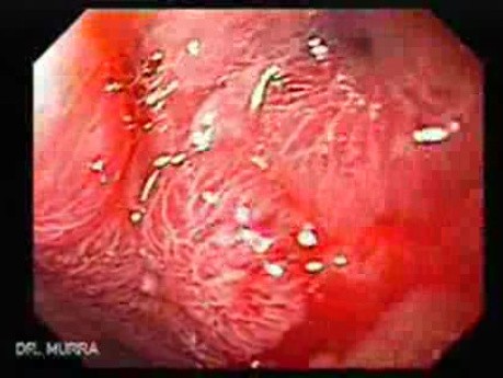 Gastric Cicatrization With Pylorus Stenosis (10 of 23)