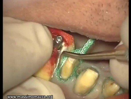 Finishing Preparations - Prosthetic Rehabilitation (3/3)