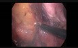 Laparoscopic Total Colectomy J-pouch Ileorectal Anastomosis
