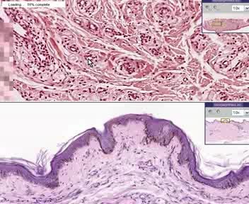 Xanthoma